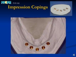 Impression Copings 