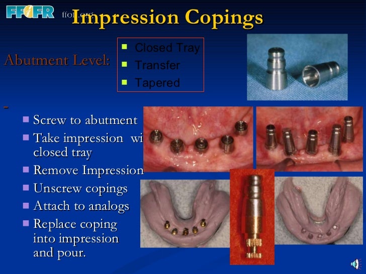 Implant components and basic techniques3