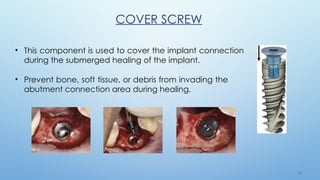 2 5
• This component is used to cover the implant connection
during the submerged healing of the implant.
• Prevent bone, soft tissue, or debris from invading the
abutment connection area during healing.
COVER SCREW
 