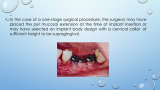 28
• In the case of a one-stage surgical procedure, the surgeon may have
placed the per mucosal extension at the time of implant insertion or
may have selected an implant body design with a cervical collar of
sufficient height to be supragingival.
 
