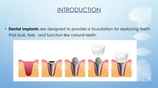 3
INTRODUCTION
• Dental implants are designed to provide a foundation for replacing teeth
that look, feel, and function like natural teeth.
 