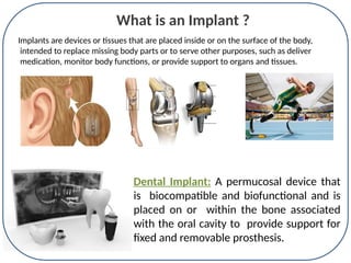 Implant Dentistry ,types of implant,methods of placement and prosthesis ...