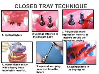 Implant Dentistry ,types of implant,methods of placement and prosthesis ...