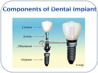 Implant Dentistry ,types of implant,methods of placement and prosthesis ...