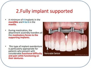 Implant Dentistry ,types of implant,methods of placement and prosthesis ...