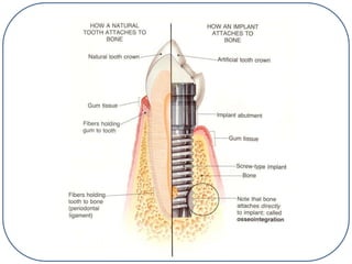 Implant Dentistry ,types of implant,methods of placement and prosthesis ...