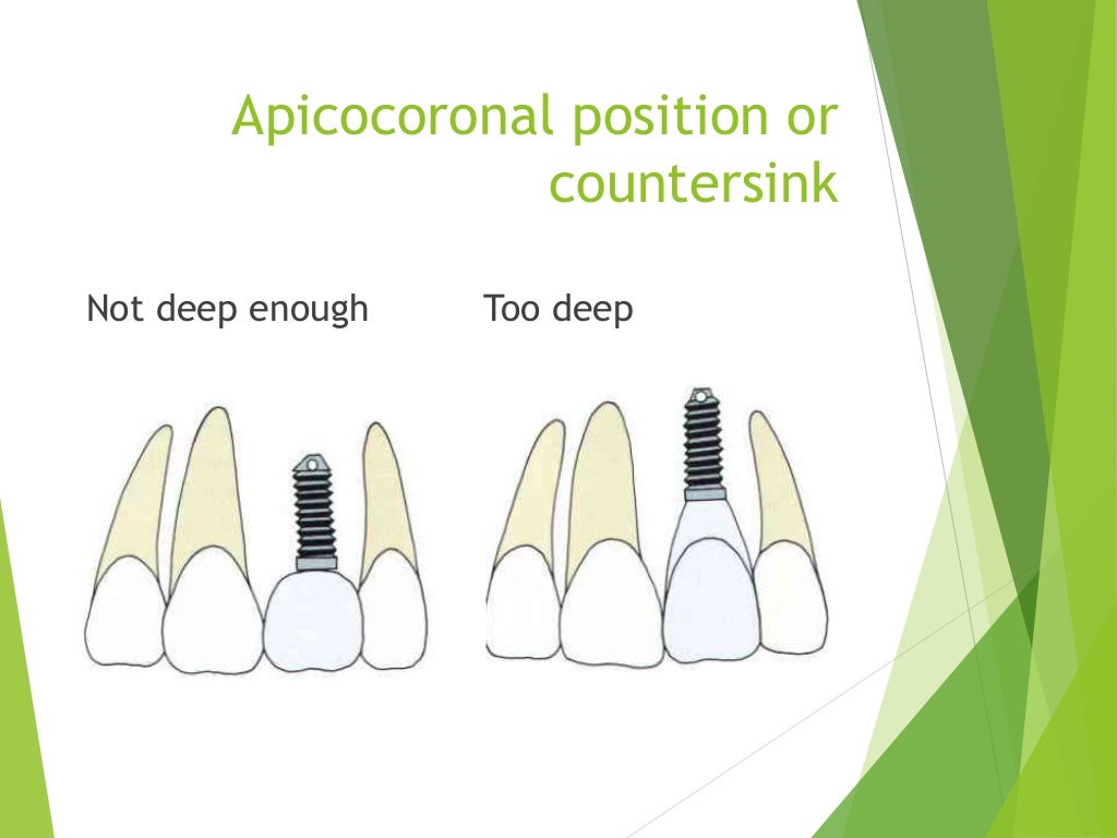 Implant dentistry in esthetic zone