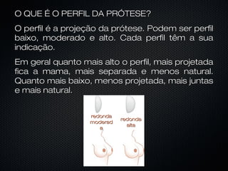 O QUE É O PERFIL DA PRÓTESE?
O perfil é a projeção da prótese. Podem ser perfil
baixo, moderado e alto. Cada perfil têm a sua
indicação.
Em geral quanto mais alto o perfil, mais projetada
fica a mama, mais separada e menos natural.
Quanto mais baixo, menos projetada, mais juntas
e mais natural.
redonda
moderad
a

redonda
alta

 