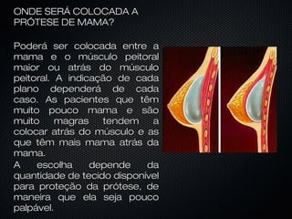 ONDE SERÁ COLOCADA A
PRÓTESE DE MAMA?
Poderá ser colocada entre a
mama e o músculo peitoral
maior ou atrás do músculo
peitoral. A indicação de cada
plano dependerá de cada
caso. As pacientes que têm
muito pouco mama e são
muito
magras
tendem
a
colocar atrás do músculo e as
que têm mais mama atrás da
mama.
A
escolha
depende
da
quantidade de tecido disponível
para proteção da prótese, de
maneira que ela seja pouco
palpável.

 