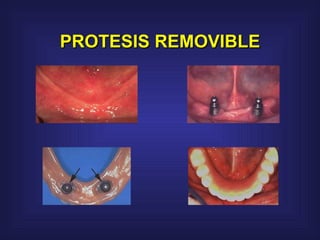 PROTESIS REMOVIBLE 
