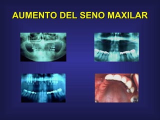 AUMENTO DEL SENO MAXILAR 