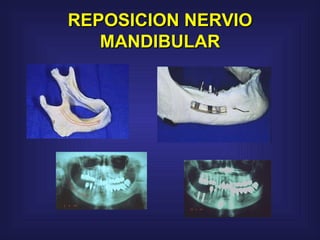 REPOSICION NERVIO MANDIBULAR 
