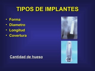 TIPOS DE IMPLANTES Forma Diametro Longitud Covertura Cantidad de hueso   