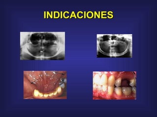INDICACIONES 