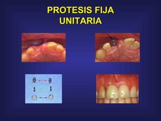 PROTESIS FIJA UNITARIA 