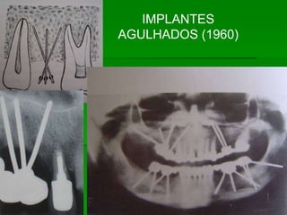 IMPLANTES AGULHADOS (1960)