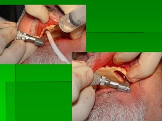 Número de implantes