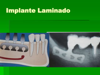 Implante Laminado
