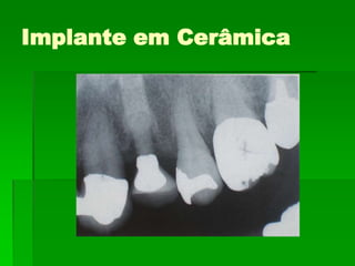 Implante em Cerâmica