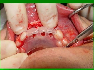 Elevação do assoalho do seio maxilar 		(sinus lifting)