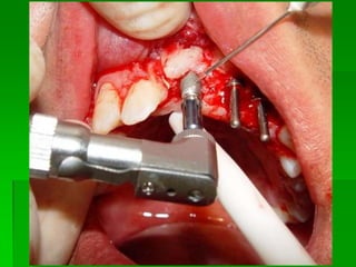 Quantidade de osso necessário