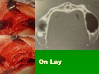 Avaliação da Altura e Largura óssea