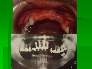 Áreas Doadoras Retro-molares