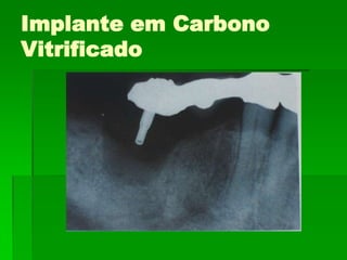 Implante em Carbono Vitrificado