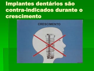 Implantes dentários são contra-indicados durante o crescimento