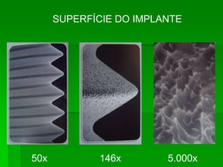 SUPERFÍCIE DO IMPLANTE50x                   146x                 5.000x