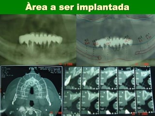 Àrea a ser implantada