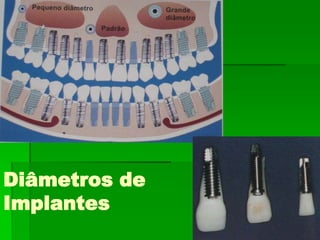 Seleção dos Implantes