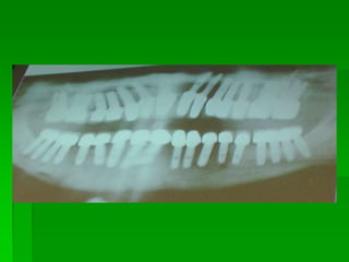 Revestida com hidroxiapatita