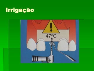 Fixação Zigomática