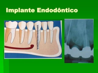 Implante Endodôntico