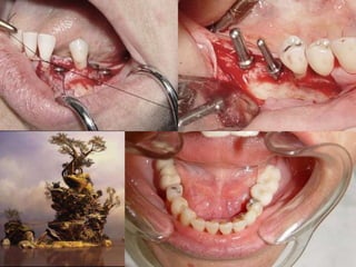 Implante de acordo com a prótese 