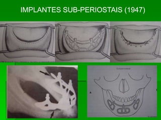 IMPLANTES SUB-PERIOSTAIS (1947)