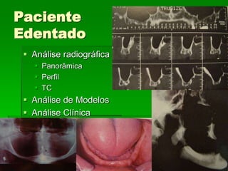 Avaliação Clínica no Momento da Instalação do ImplanteAparelhos especiais Osstell (mede por freqüência e ressonância)Avaliação Clínica (estabilidade)Torquímetro (mínimo 45 Newtons)Avaliação   radiográfica   ( durante   a instalação,  mede  a  distância   entre implantes e estruturas adjacentes)
