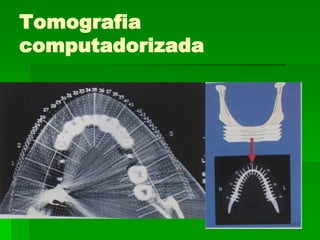 Avaliação Clínica Após Período de Osseointegração Imobilidade ClínicaAssintomáticoAusência de imagem radiolúcida peri-implantarAusência de neuropatiaPerda óssea vertical inferior a 1,0 mm após o primeiro ano em  função, e  de   0,1 mm nos anos seguintes
