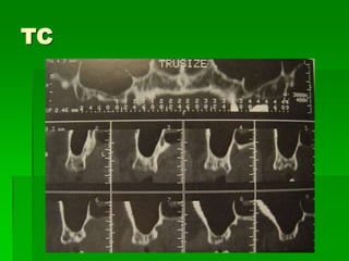 Paciente EdentadoAnálise radiográficaPanorâmicaPerfilTCAnálise de ModelosAnálise Clínica