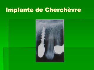 Implante de Cherchèvre