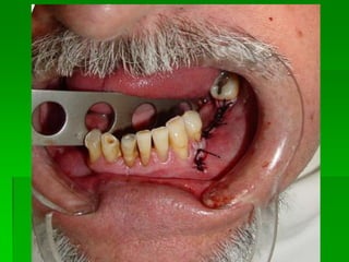 Mandíbula Parcialmente EdentadaQualidade do ossoPosição do feixe neurovascularComprimento dos implantesTamanho do espaço edentadoTipo de carga oclusal