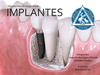 IMPLANTES
Integrantes:
Alejandra Rodríguez Estrada
Daniela González
Docentes:
Brenda Gómez
Introducción a la cirugía bucal
 