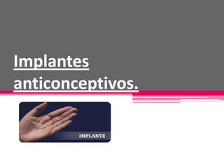 Implantes
anticonceptivos.
 