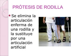 PRÓTESIS DE RODILLA
Se elimina la
articulación
enferma de
una rodilla y
la sustituye
por una
articulación
artificial
 
