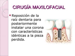 CIRUGÍA MAXILOFACIALCIRUGÍA MAXILOFACIAL
Reposición de la
raíz dentaria para
posteriormente
instalar una corona
con características
idénticas a la pieza
perdida.
 