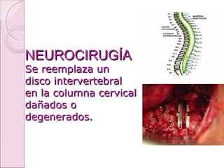 NEUROCIRUGÍANEUROCIRUGÍA
Se reemplaza unSe reemplaza un
disco intervertebraldisco intervertebral
en la columna cervicalen la columna cervical
dañados odañados o
degenerados.degenerados.
 