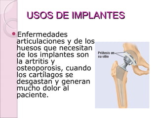 USOS DE IMPLANTESUSOS DE IMPLANTES
Enfermedades
articulaciones y de los
huesos que necesitan
de los implantes son
la artritis y
osteoporosis, cuando
los cartílagos se
desgastan y generan
mucho dolor al
paciente.
 