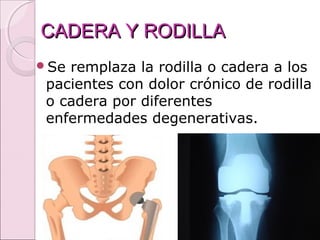 CADERA Y RODILLACADERA Y RODILLA
Se remplaza la rodilla o cadera a los
pacientes con dolor crónico de rodilla
o cadera por diferentes
enfermedades degenerativas.
 
 