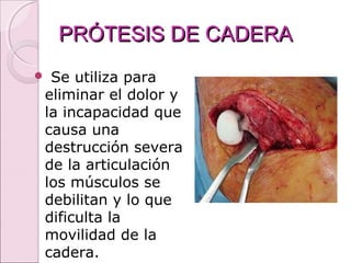 PRÓTESIS DE CADERAPRÓTESIS DE CADERA
 Se utiliza para
eliminar el dolor y
la incapacidad que
causa una
destrucción severa
de la articulación
los músculos se
debilitan y lo que
dificulta la
movilidad de la
cadera.
 